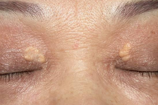 胆固醇|血脂高，头部先知！再次提醒：头部若有3种异常，血管或已“水泄不通”