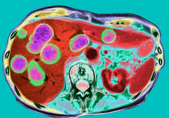 肝脏|31岁单身爸爸确诊肝癌，懊悔痛哭，身体早有迹象，可惜被他忽视了