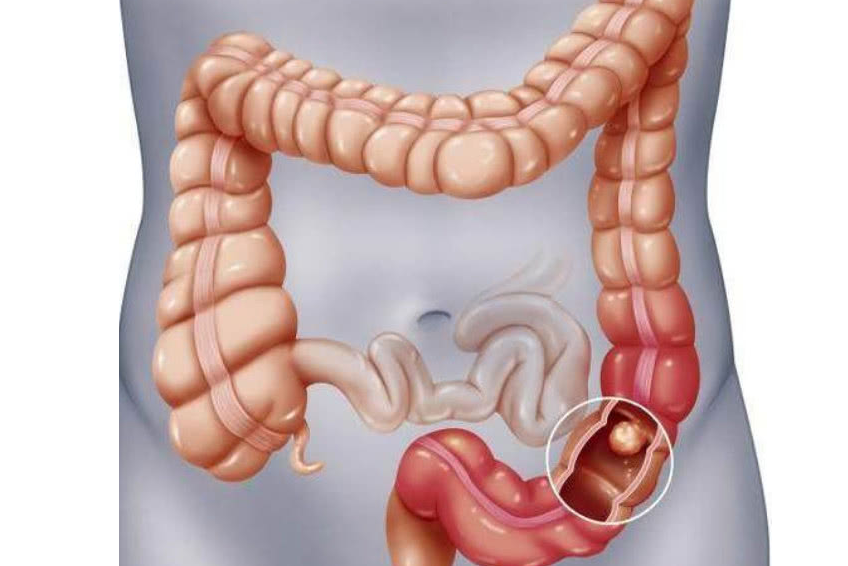 饮食|肠道“爱”长息肉？别担心，坚持2件事，肠道或能更平滑