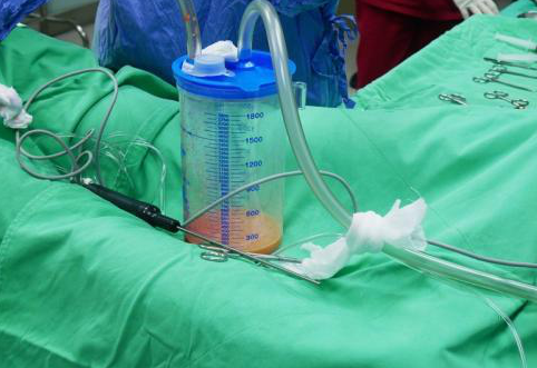 社会热点传播正能量 女子为美涉险美容院全麻抽脂，药物引起呼吸抑制，或将命丧黄泉