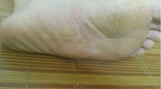 肝脏|肝不好，脚先知？医生提醒：双脚出现3种“异常”，尽早去做肝功检查