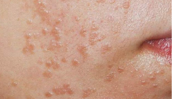 朱医生讲健康 22岁女子误把HPV当过敏，疣体满脸几乎毁容，3个症状或是HPV