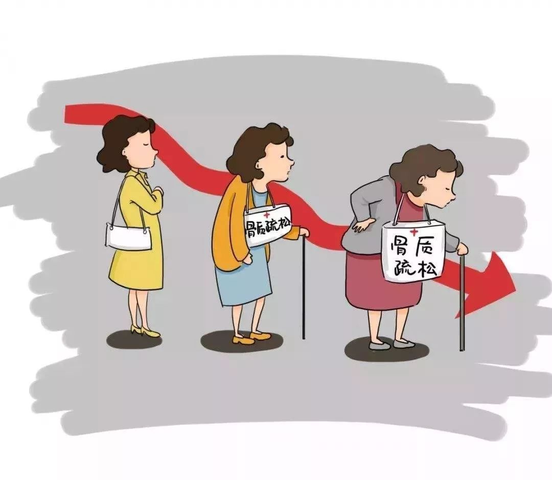 醫生|55歲女子查出骨疏松，險離世，醫生：身體早有警示，她沒留意