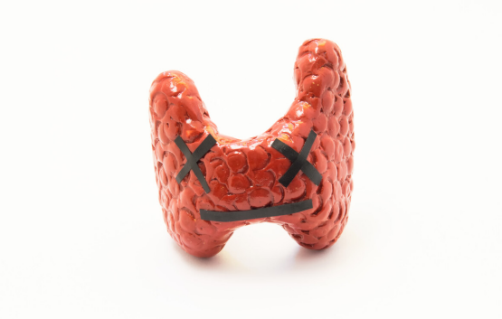 脂肪肝|甲减患者不能喝豆浆？医生：若想甲功稳定，3种食物尽量不碰