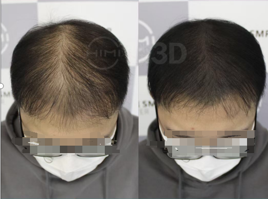 脱发|脱单未成先脱发，年轻人防脱注意这三点