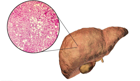 高血脂|心血管科主任提醒:降血脂没有捷径,平时做好这3件事,了解一下
