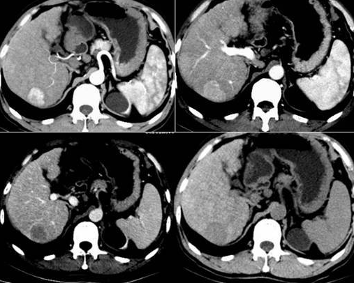 鸡蛋|女子肩痛入院，查出肝癌，医生怒斥：常吃1种鸡蛋，铁打的肝也扛不住