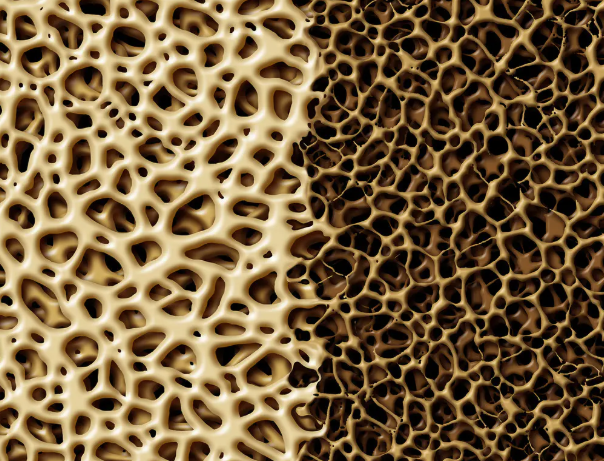 骨质疏松|骨质疏松“元凶”被揪出，有这2个坏习惯，难怪腰酸背痛“找上门”