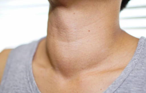 甲状腺癌|41岁快递员确诊甲状腺癌，医生叹息：“1黄”吃一口等于10斤咸菜，趁早扔掉