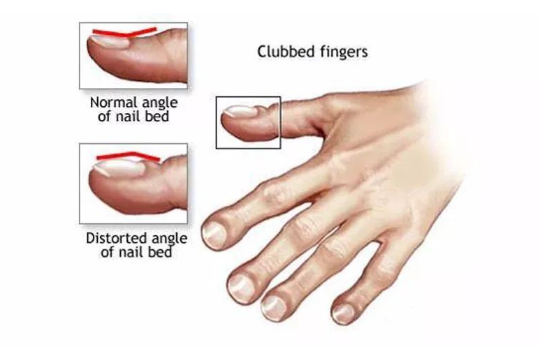 肺癌|男性上半身有4种“异常”,肺或已“烂如蜂窝”,若你没有,肺还算轻松