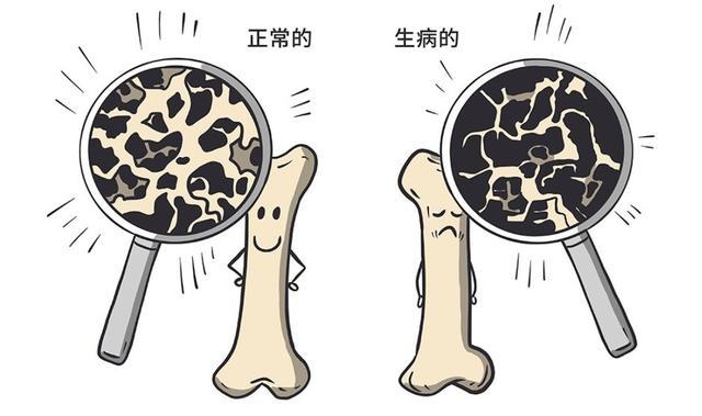 骨质疏松|骨质疏松碰到“天敌”了，不是牛奶和虾皮，你若爱吃，骨密度蹭蹭往上涨