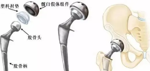 我叫小王|股骨头坏死置换不能一劳永逸