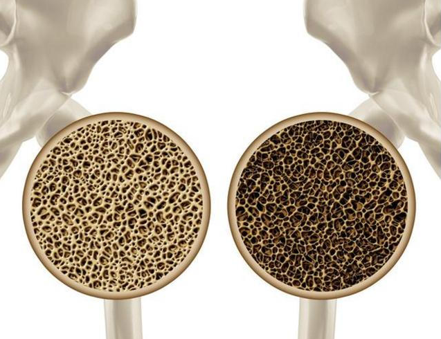 医生|1味调料竟能害人命,骨科医生:不想骨头成粉末,劝你趁早远离