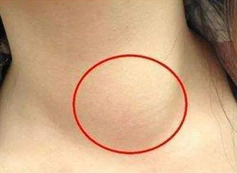 痛风|甲状腺天然的“保护伞”被发现,不是山药,你若爱吃,结节或慢慢消失