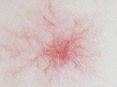 高血脂|身体2处“发痒”,别误以为是过敏了,或是肝脏癌变发出的求救信号