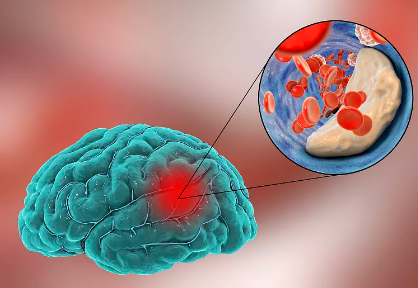 睡眠|脑梗多是“拖”出来的,医生提醒:睡觉时有3种表现,趁早查脑CT