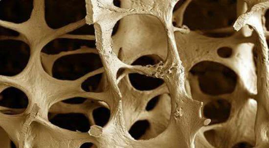 医生|喝一次等于喝3斤白酒，骨科医生：常喝让你骨头变成“马蜂窝”