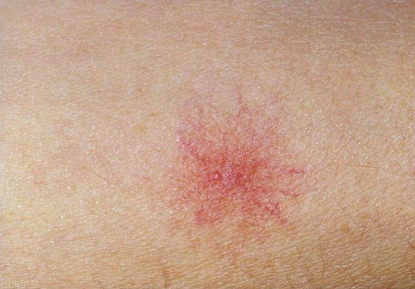 天天听健康|40岁女子肝癌入院，不久离世，提醒：1种“粗粮”比烟酒还伤肝，劝你别吃！