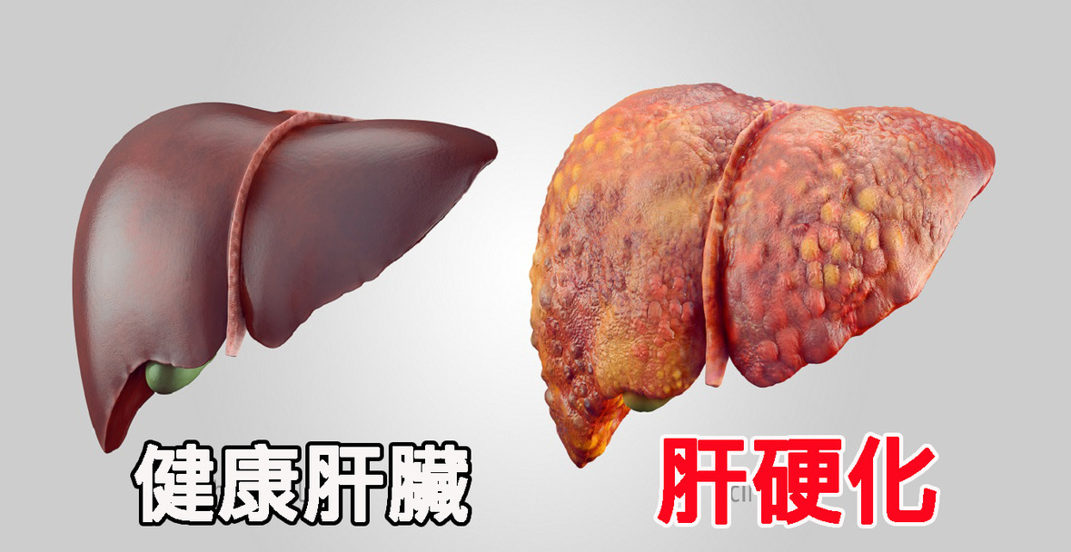 睡眠|身上2处瘙痒,肝脏或已“硬如石头”,若占其一,趁早检查肝CT