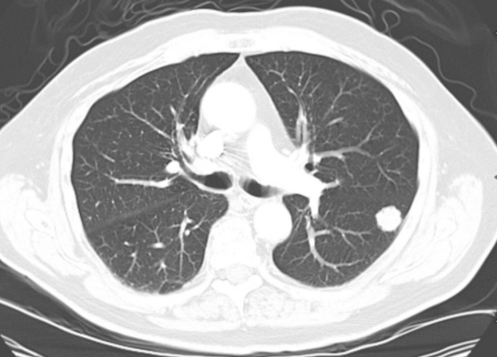 海带|吃一次等于5斤海带，心肺科主任：没事喝2口，散“结节”，肺越来越红润