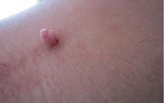 朱医生讲健康 感染HPV半年，还没有转阴？医生：教你几招，“赶跑”HPV很容易