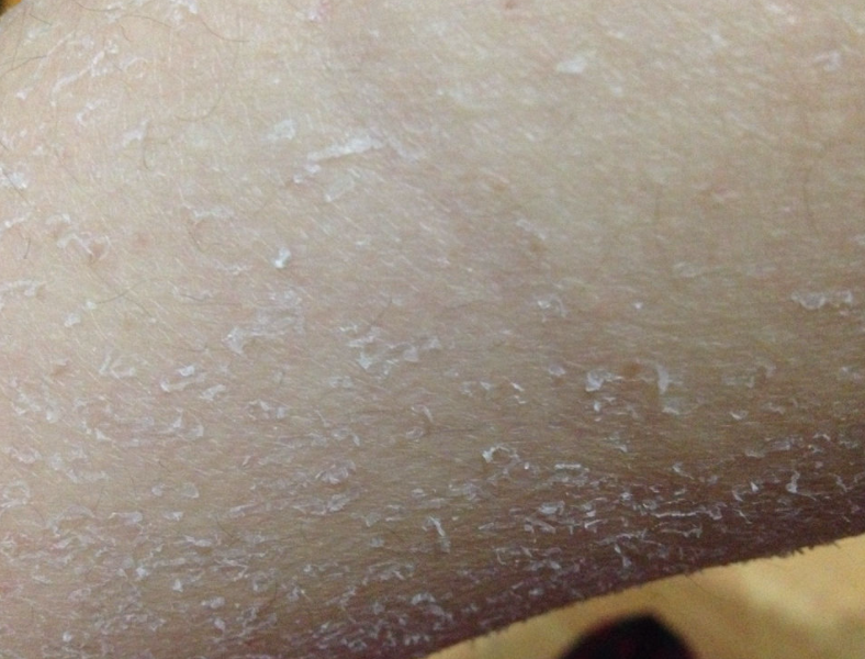 肝脏|肝脏内科医生:补充一种“素”,肝小叶清晰无污染