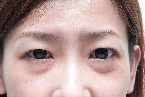 尿酸|早上醒来，身体若有5种情况，或是暗示尿酸“超标”，很多人不当回事