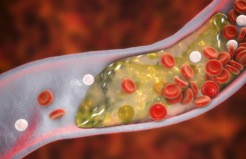 睡眠|橙子是升高血脂的“催化剂”？心血管主任：冬季远离2种水果，血脂稳定