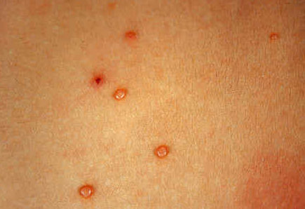 千金芳 程序员身上起“肉瘤”是感染HPV？还可能转癌？医生：是真的