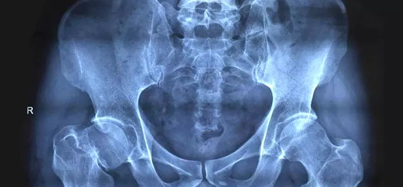 我叫小王|下肢畏寒无力，小心股骨头坏死病变