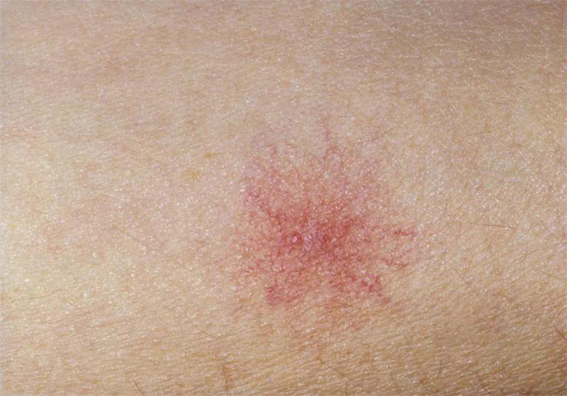 花生|手上若有3个“记号”，多半肝脏已硬化，提醒：护肝坚持3件事