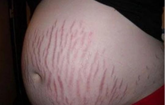 颜建晖说育儿|孕期什么样的孕妈不容易长妊娠纹？