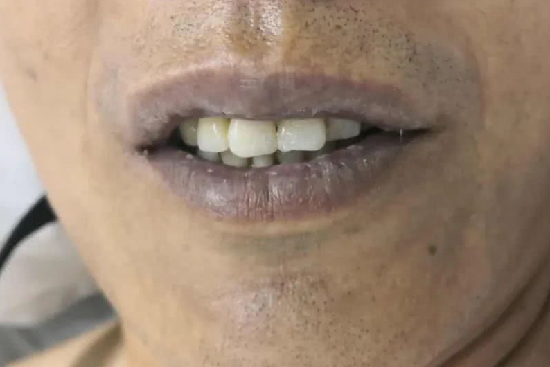 肺癌|男性上半身有4种“异常”,肺或已“烂如蜂窝”,若你没有,肺还算轻松