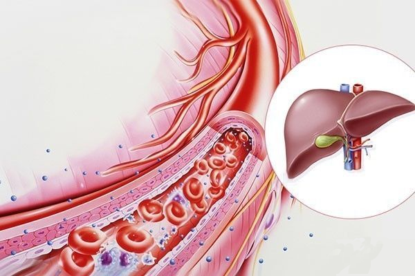 血糖|肝癌出现腹水还有救吗？43岁的他生活如同常人，靠的就是这个方法