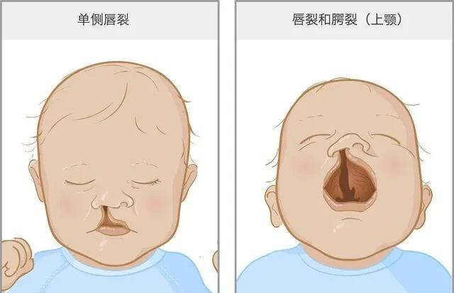 幸福如猪|兔唇宝宝是孕期什么阶段及什么原因造成的？