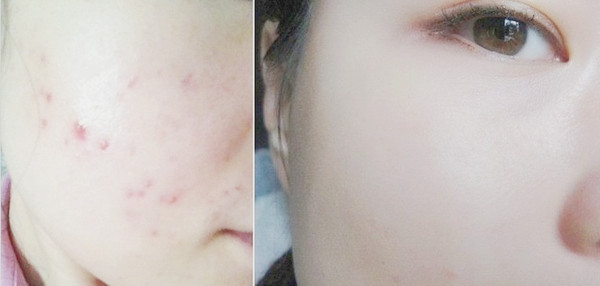 珍珍祛痘护肤|皮肤坑洼痘印满天飞怎么办，这里是祛痘印最好的方法！