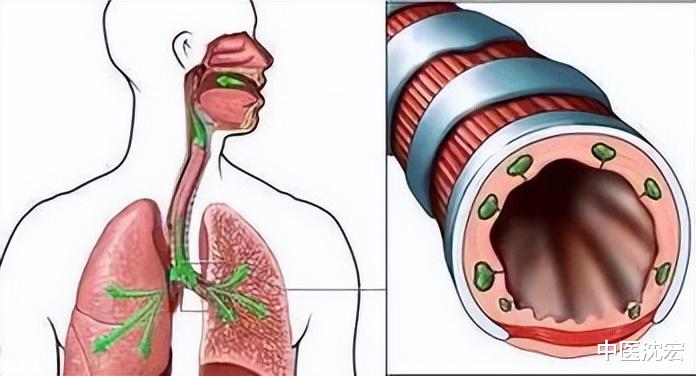 咳嗽|痰多咳嗽、上实下虚?送你一张千古降痰名方!上清肺痰,下补肾阳