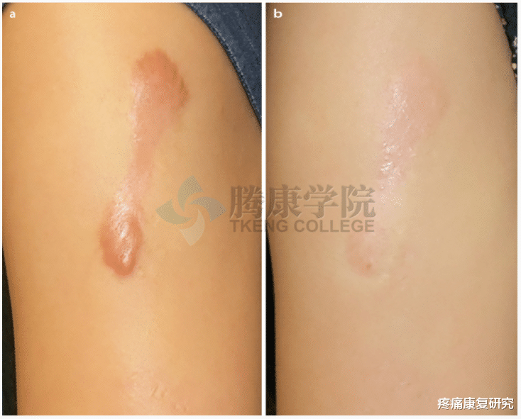 皮炎|皮质类固醇贴剂治疗瘢痕疙瘩和增生性瘢痕