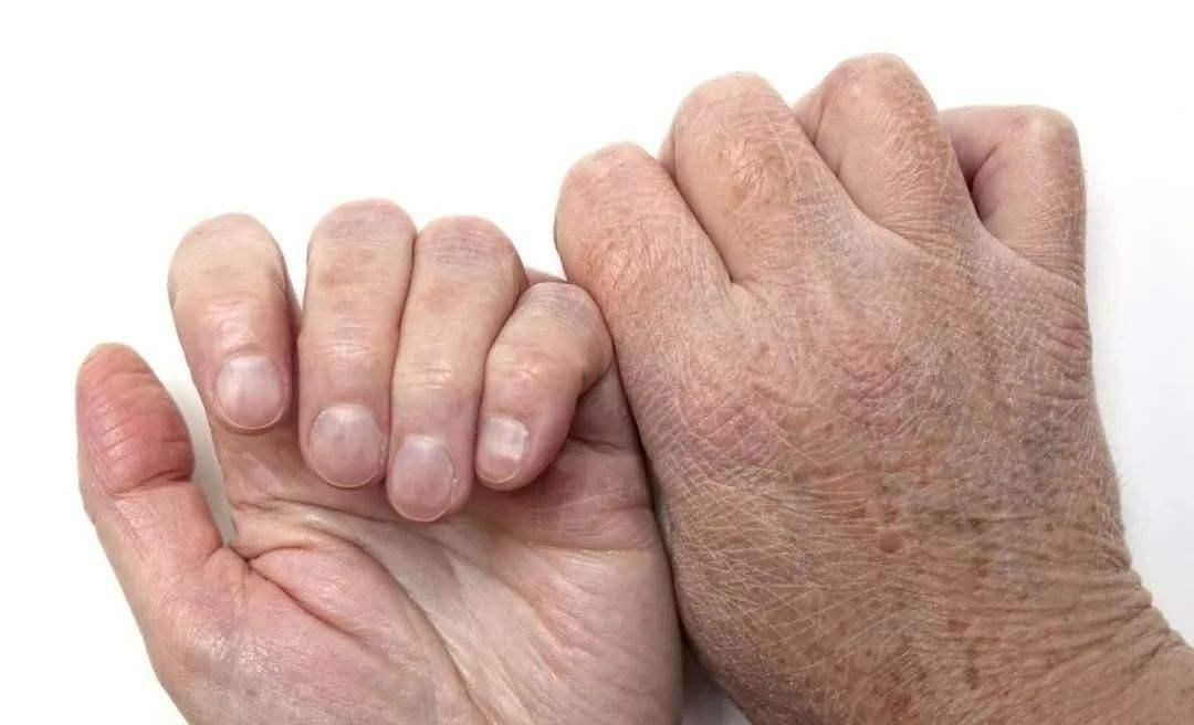 皮肤瘙痒|瘙痒不一定是皮肤干燥,或许是身体内脏出了问题,几种病因要警惕