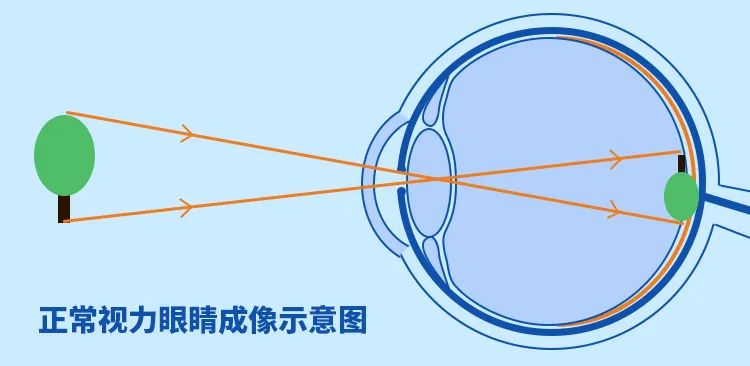 近视|你知道眼睛是如何工作的吗?