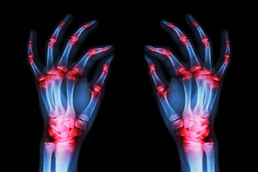 尿酸|你爱喝的这种饮料,可能偷偷升高你的尿酸!饮食上劝你注意这3点