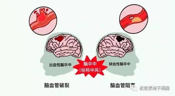 干细胞治疗脑梗死的应用和安全性的研究进展