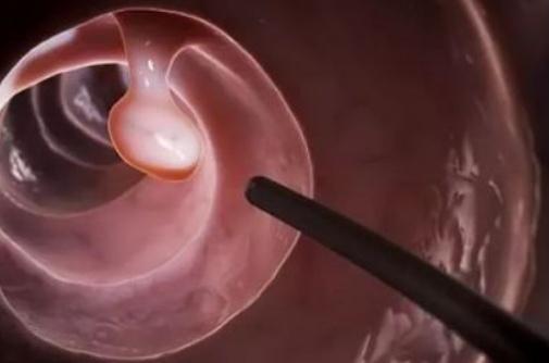 肠息肉|身体出现这3个症状,可能是长肠息肉了,最好别再后知后觉