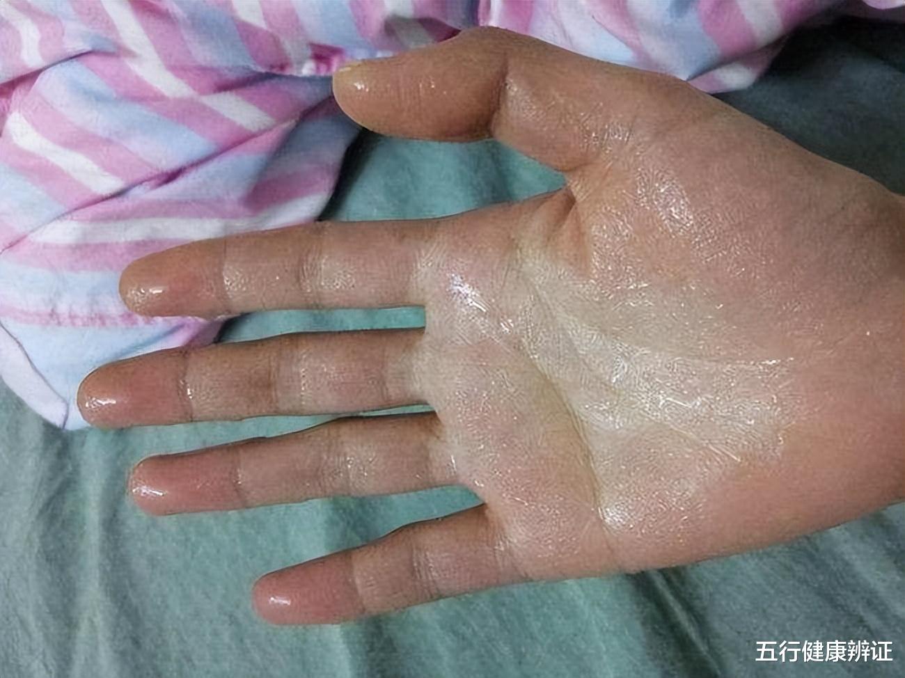 养生|“手心多汗,全身大乱”,是什么原因?3味药外用,或可收涩止汗