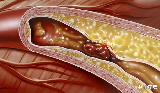 陈皮|世间本无病,只是痰和瘀!3味药,一味活血、一味化痰、一味养阴