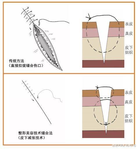 |颜值为王的时代,掌握这2种方法,帮你战胜术后“外貌焦虑”!