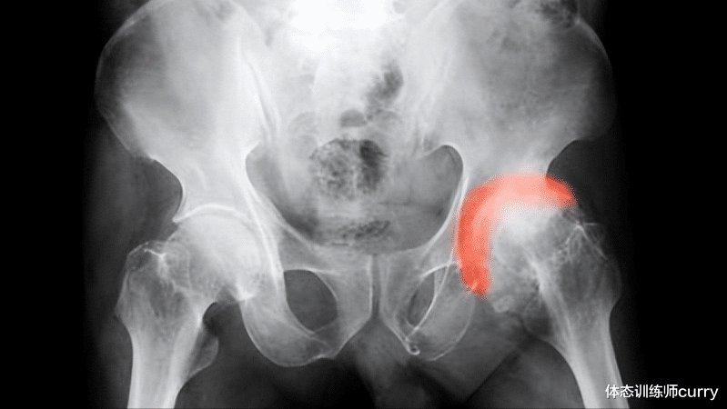 股骨头坏死|身体出现哪些特征,要小心股骨头坏死?常见的治疗方式有什么