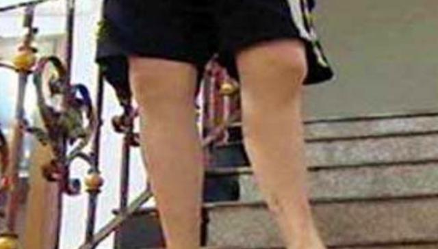 迪士尼|曾花16万断骨,只为长高7.2厘米的李亚诺,如今与后遗症为伴