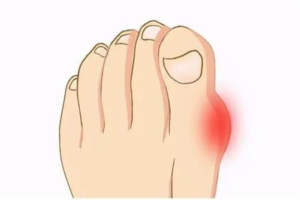 高血压|痛风性关节炎患者能喝酒吗？除禁酒外日常这些要注意