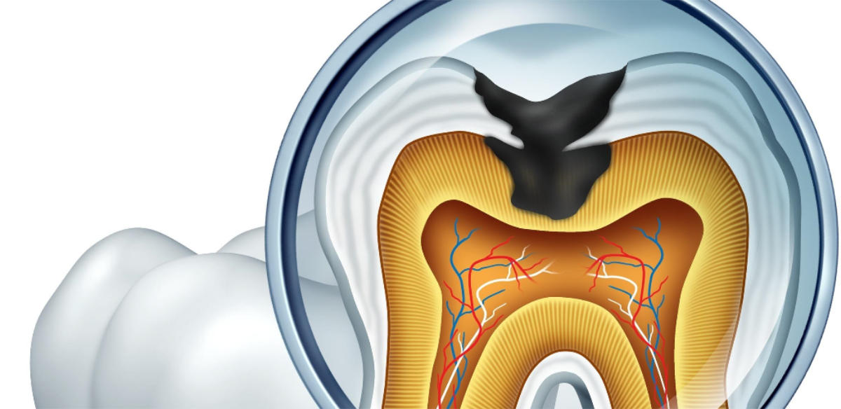 |得了“蛀牙”怎么办?